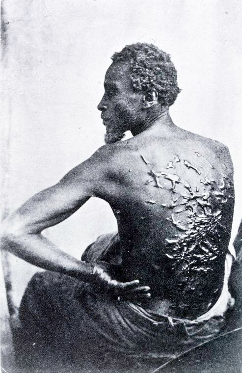 The Scourged Back - The furrowed and scarred back of Gordon, a slave who escaped from his master in Mississippi and made his way to a Union Army encampment in Baton Rouge, Louisiana, 1863.