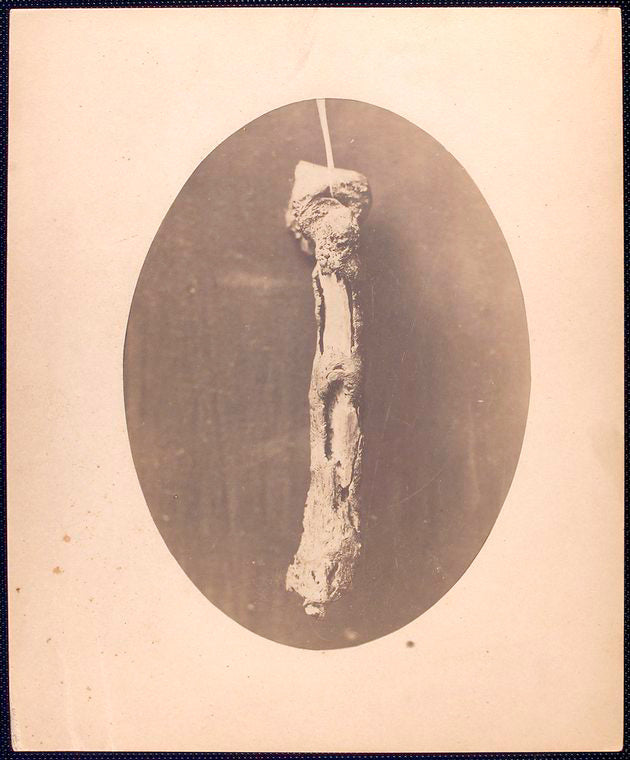 Humerus removed from right arm of John F. Claghorn, 214 Gold St. Brooklyn, L.I. Operation performed by Dr. James B. [Cutter or Cutler], 384 Broad St. Newark N.J. / Johnson  D’Utassy, Photographers