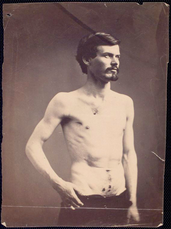 James Brownlee : Wounds in chest & abdomen [Three-quarter view, shirtless man standing, clothing adjusted to show gunshot wounds to chest and lower abdomen]