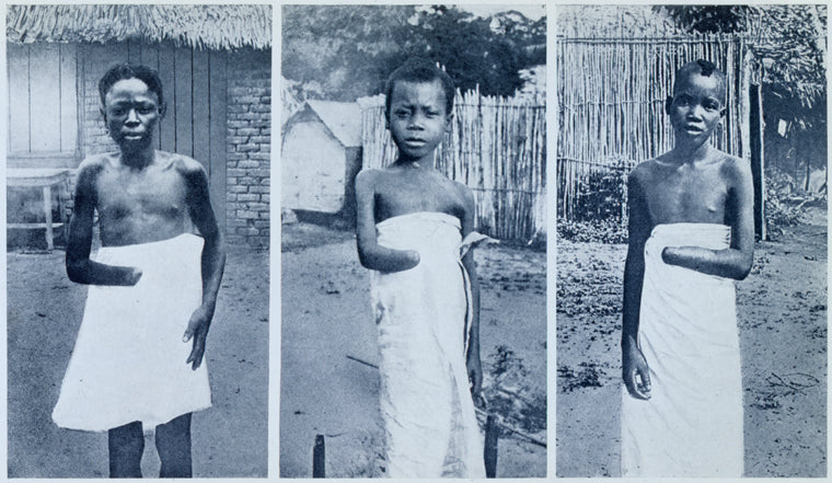 Children mutilated by Congo soldiers (Ikabo, Lokota, Epondo)