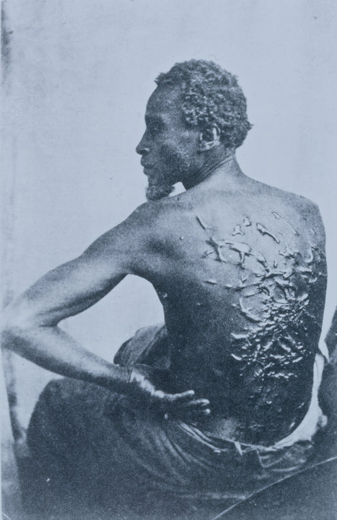 The Scourged Back - The furrowed and scarred back of Gordon, a slave who escaped from his master in Mississippi and made his way to a Union Army encampment in Baton Rouge, Louisiana, 1863.