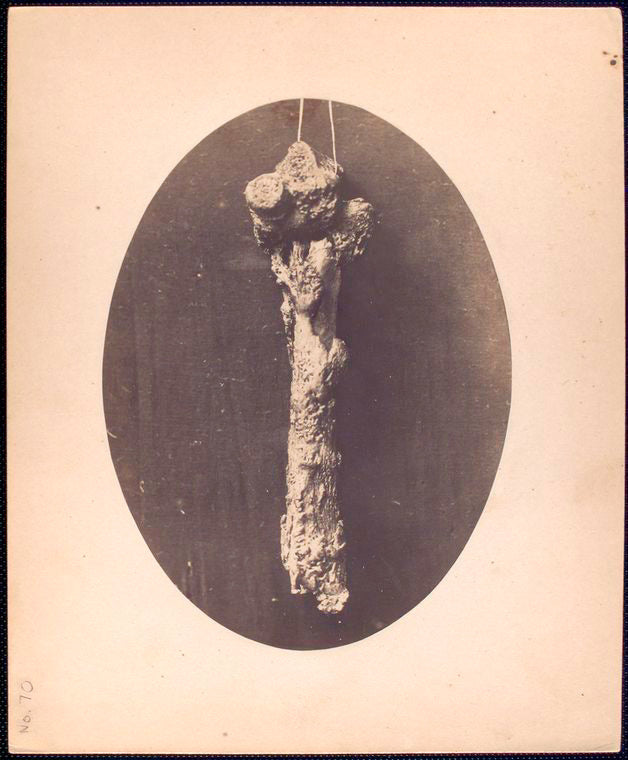 Humerus removed from right arm of John F. Claghorn, 214 Gold St. Brooklyn, L.I. Operation performed by Dr. James B. [Cutter or Cutler], 384 Broad St. Newark N.J. / Johnson  D’Utassy, Photographers