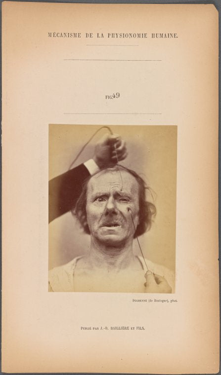 Fig. 49 : To study the association of m. zygomaticus minor and m. corrugator supercilii in the same subject.